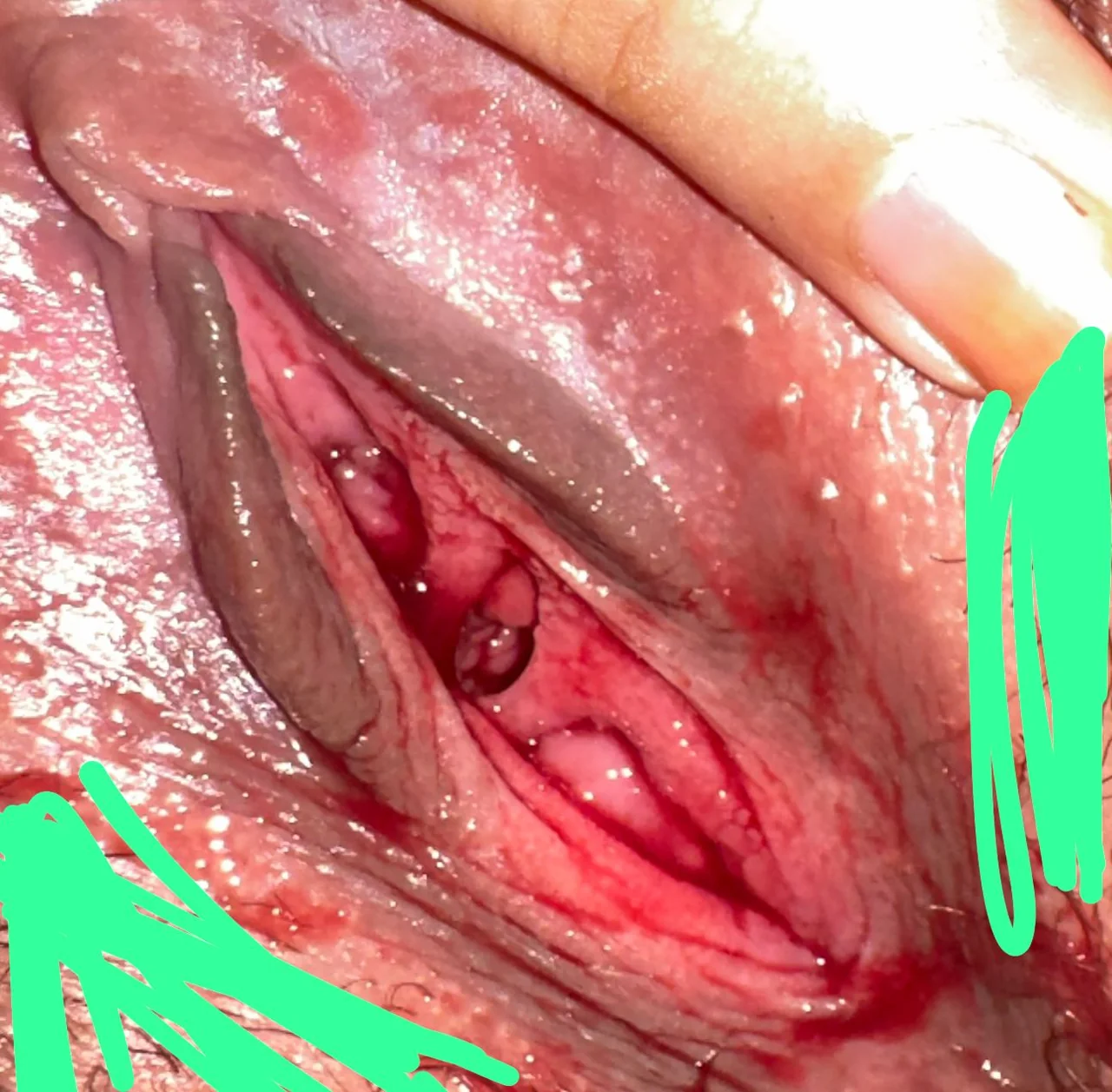 ترقيع الغشاء بالليزر | Hymenoplasty illustrative image