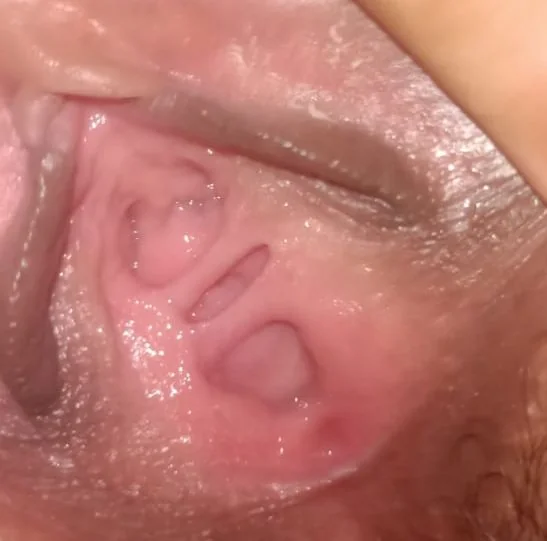 تشغيل غشاء بكارة مؤقت | Hymenoplasty illustrative image