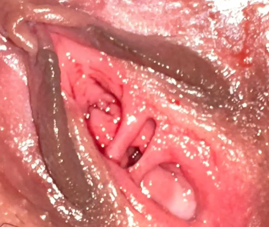 عملية ترميم دقيقة | Hymenoplasty illustrative image