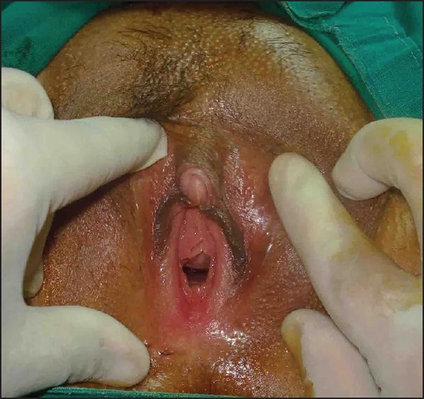 ترقيع غشاء دائم | Hymenoplasty illustrative image