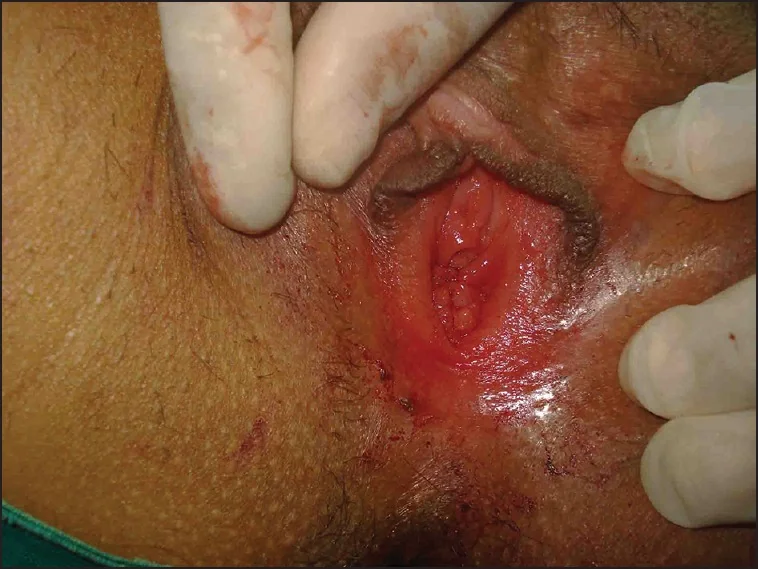 الفرق بين الترقيع المؤقت والدائم | Hymenoplasty illustrative image