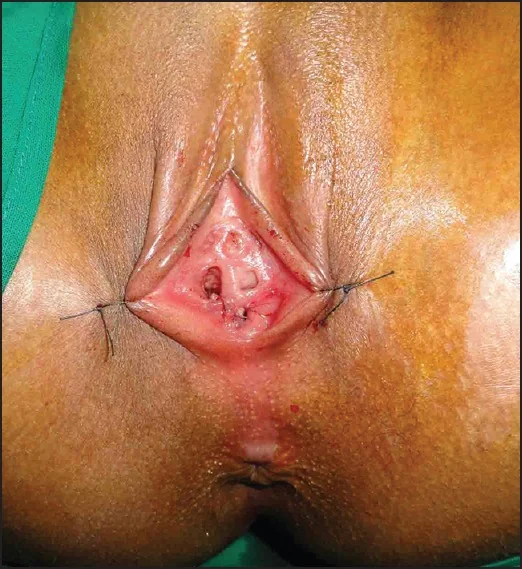 هل الترقيع مؤلم؟ | Hymenoplasty illustrative image