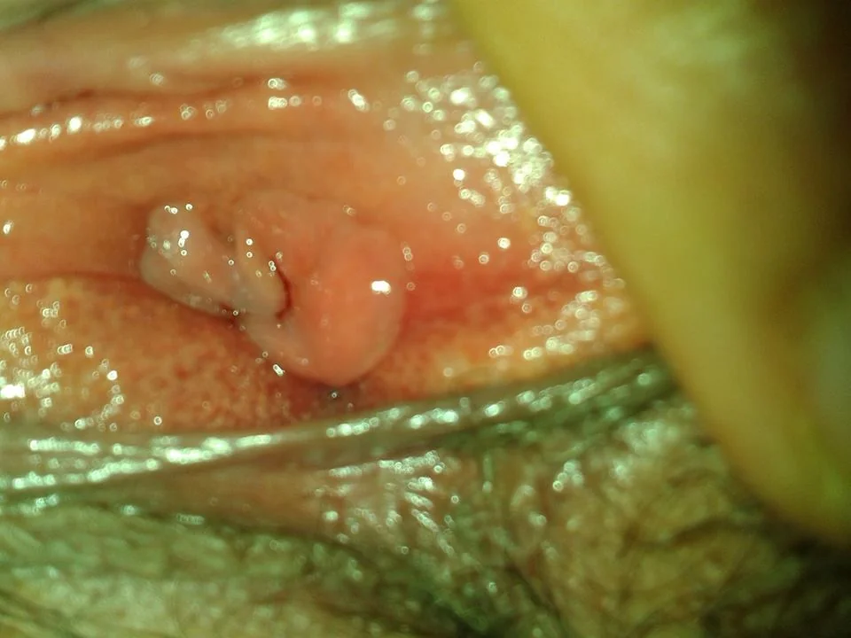 هل الترقيع آمن؟ | Hymenoplasty illustrative image